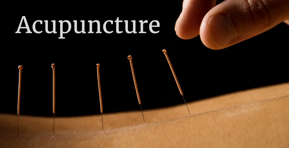 Acupuncture needles placed along the back